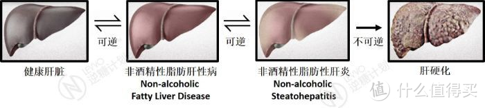 中年男人最常见的疾病之一的脂肪肝，我是怎样通过锻炼治愈的